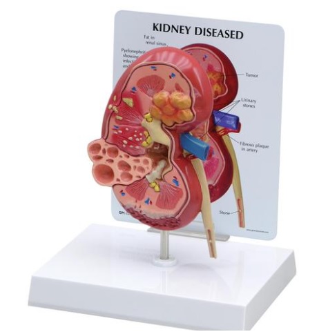 Model ľudskej obličky s ochorením