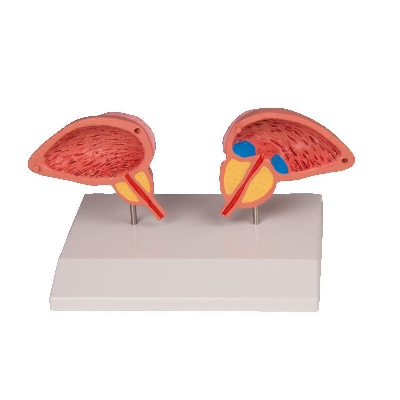 Model mužská prostata, 2-dielny model BPH