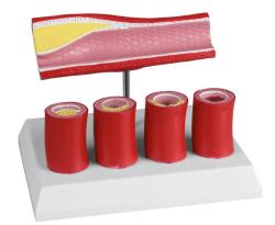 Model udskej tepny EZ - Aterosklerza (4 prierezy)