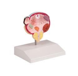 Model ochorenia moovho mechra a prostaty