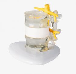 Simultor hernie - vyklenutie medzistavcovej platniky