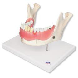 Model - Zubn ochorenia